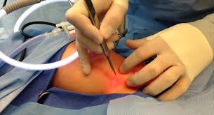 Hernia Repair Surgery